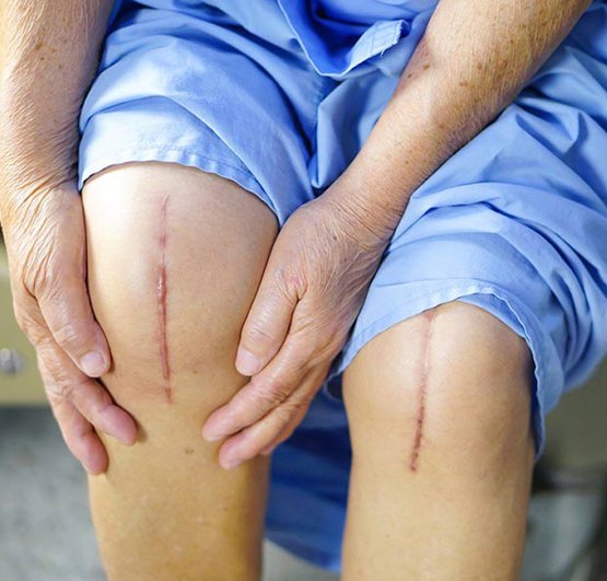 arunvontela-knee-replacement